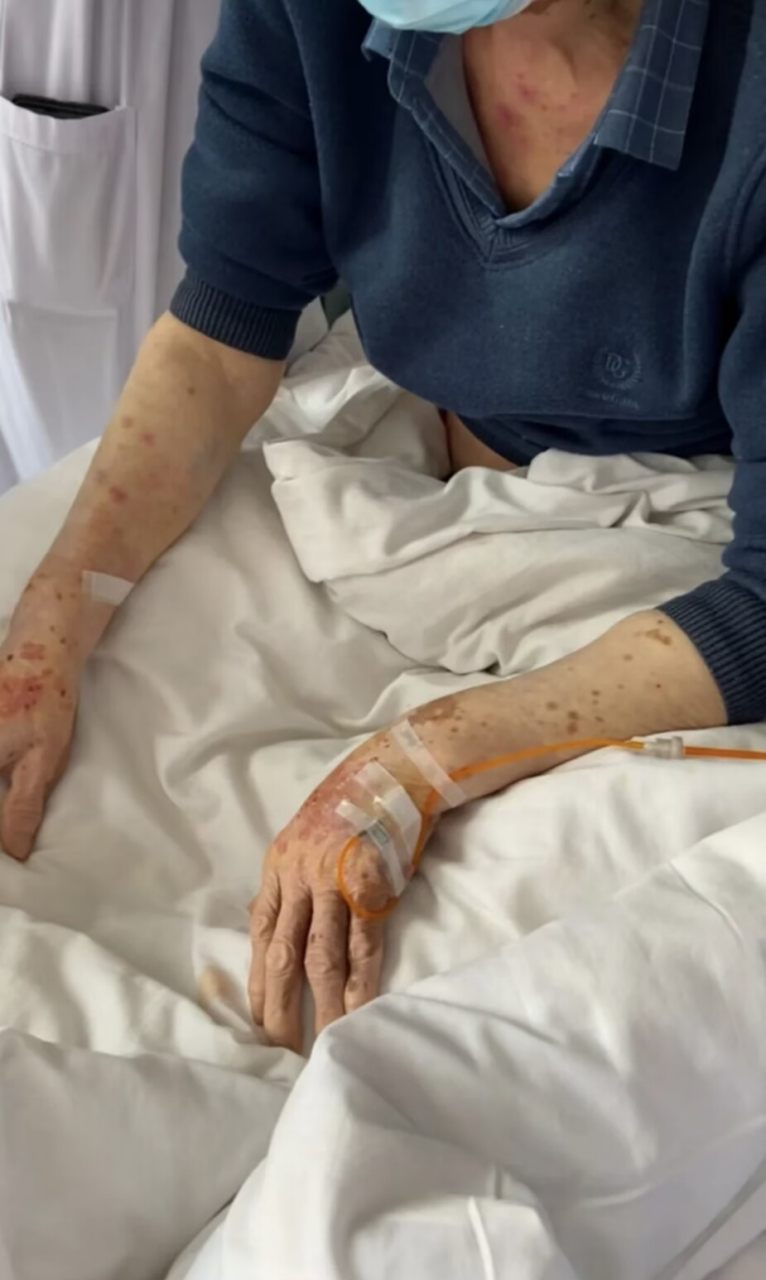 肝病朋友皮肤出现它,要小心肝硬化!