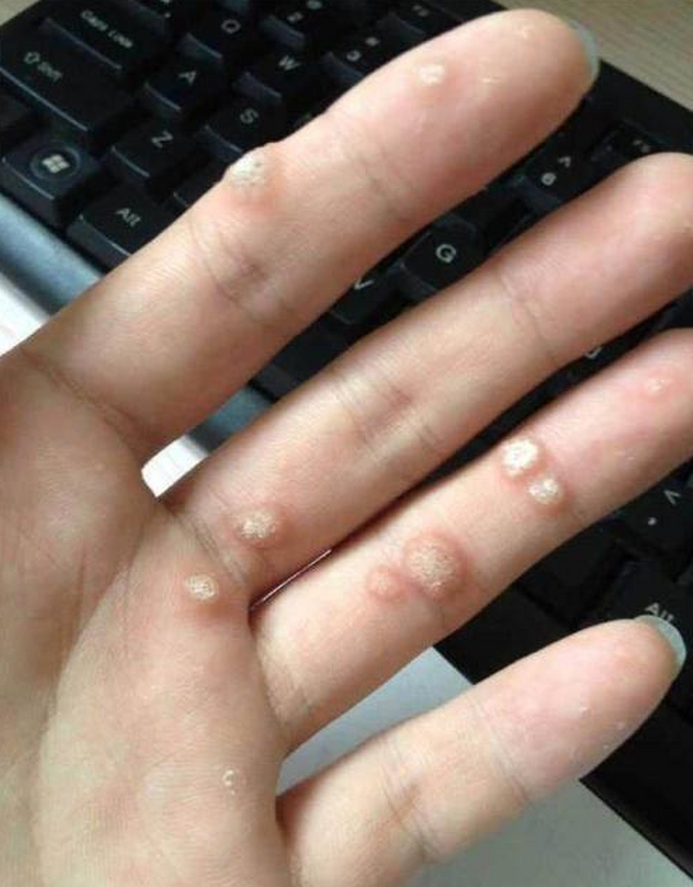 这种就是俗称的"刺瘊子",在临床医学上,称寻常疣.