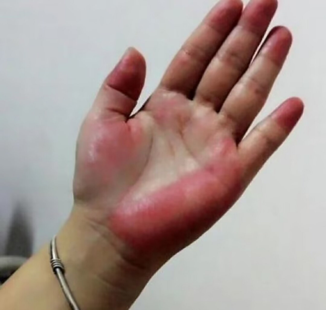手掌红是咋回事?