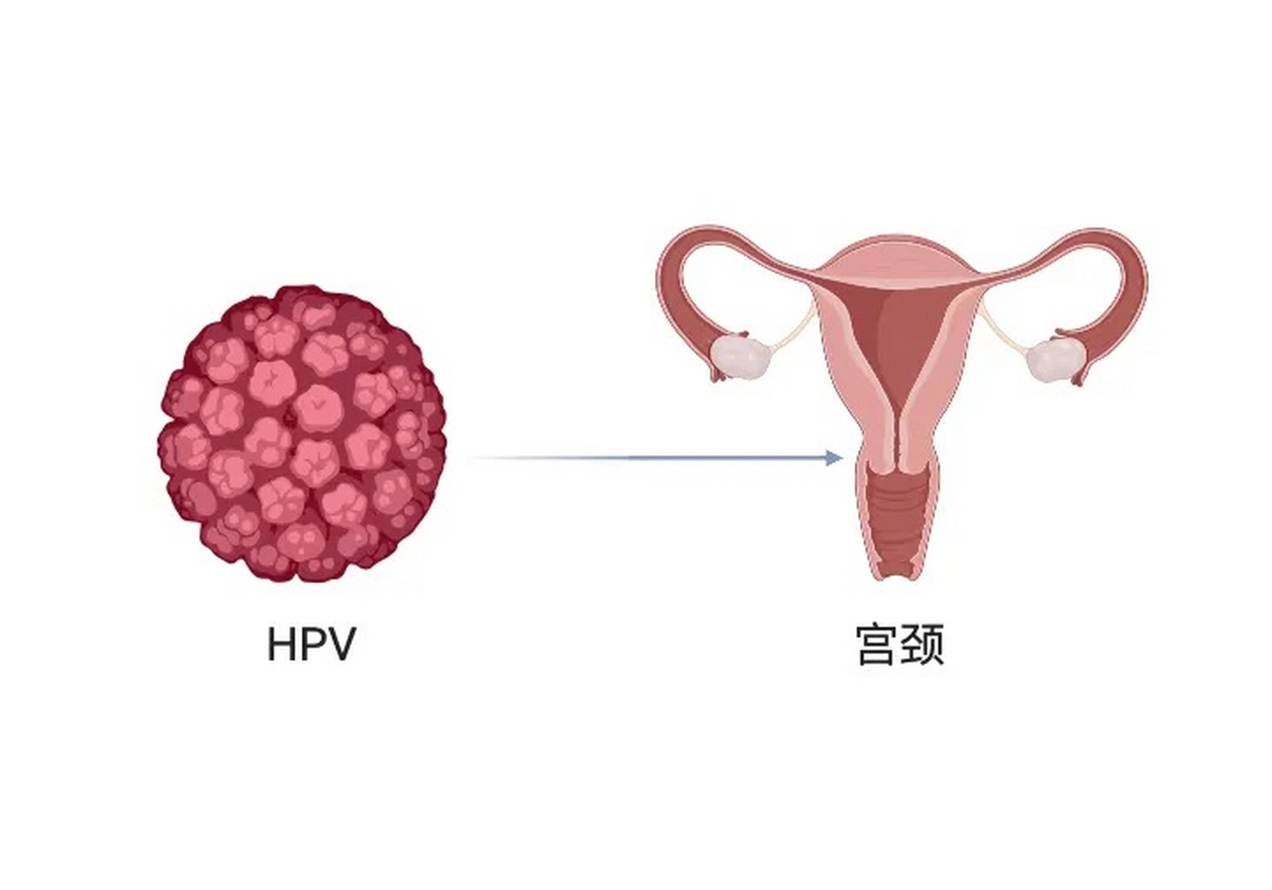 女性宫颈感染hpv病毒有什么症状 女性宫颈感染hpv通常没有症状,具体