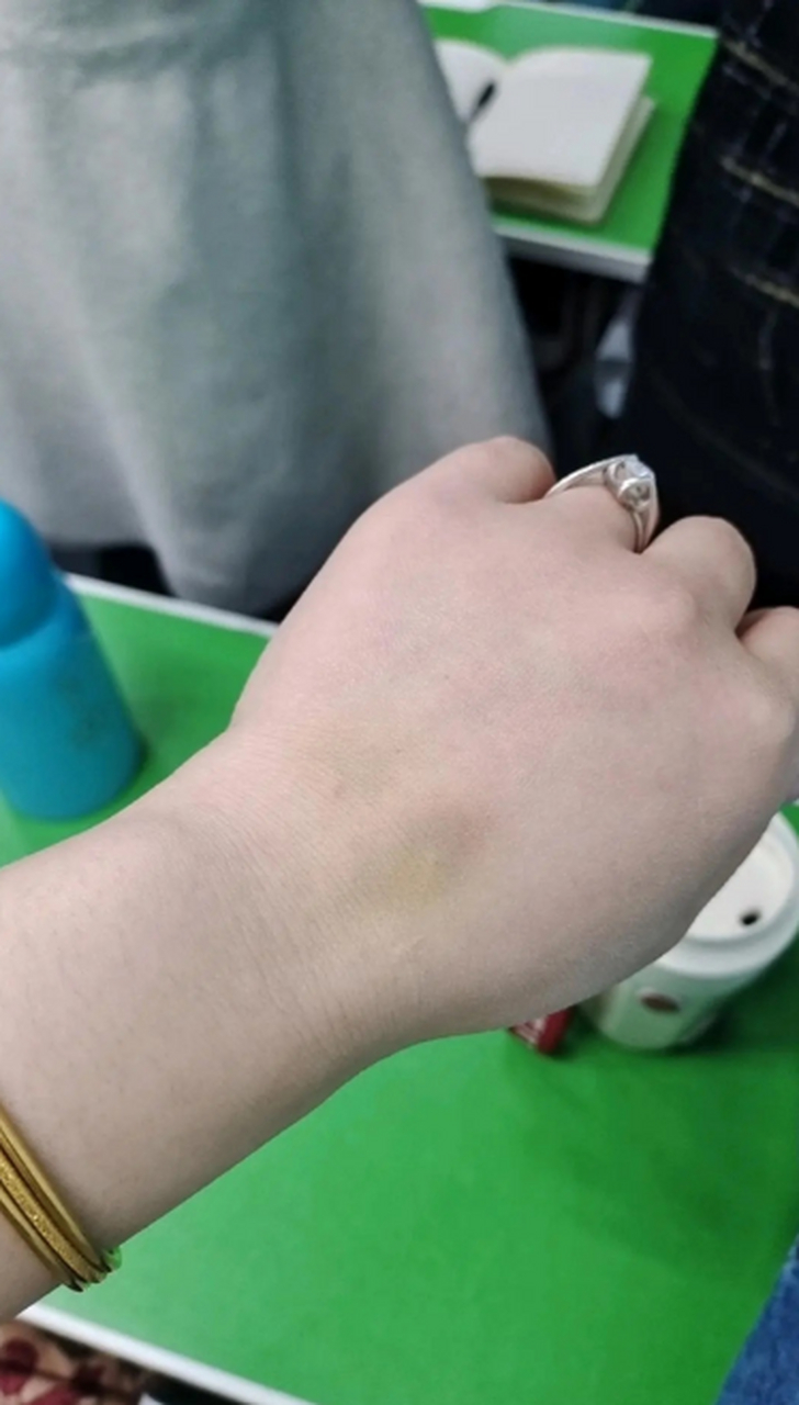 手臂上的淤青怎么快速去除?