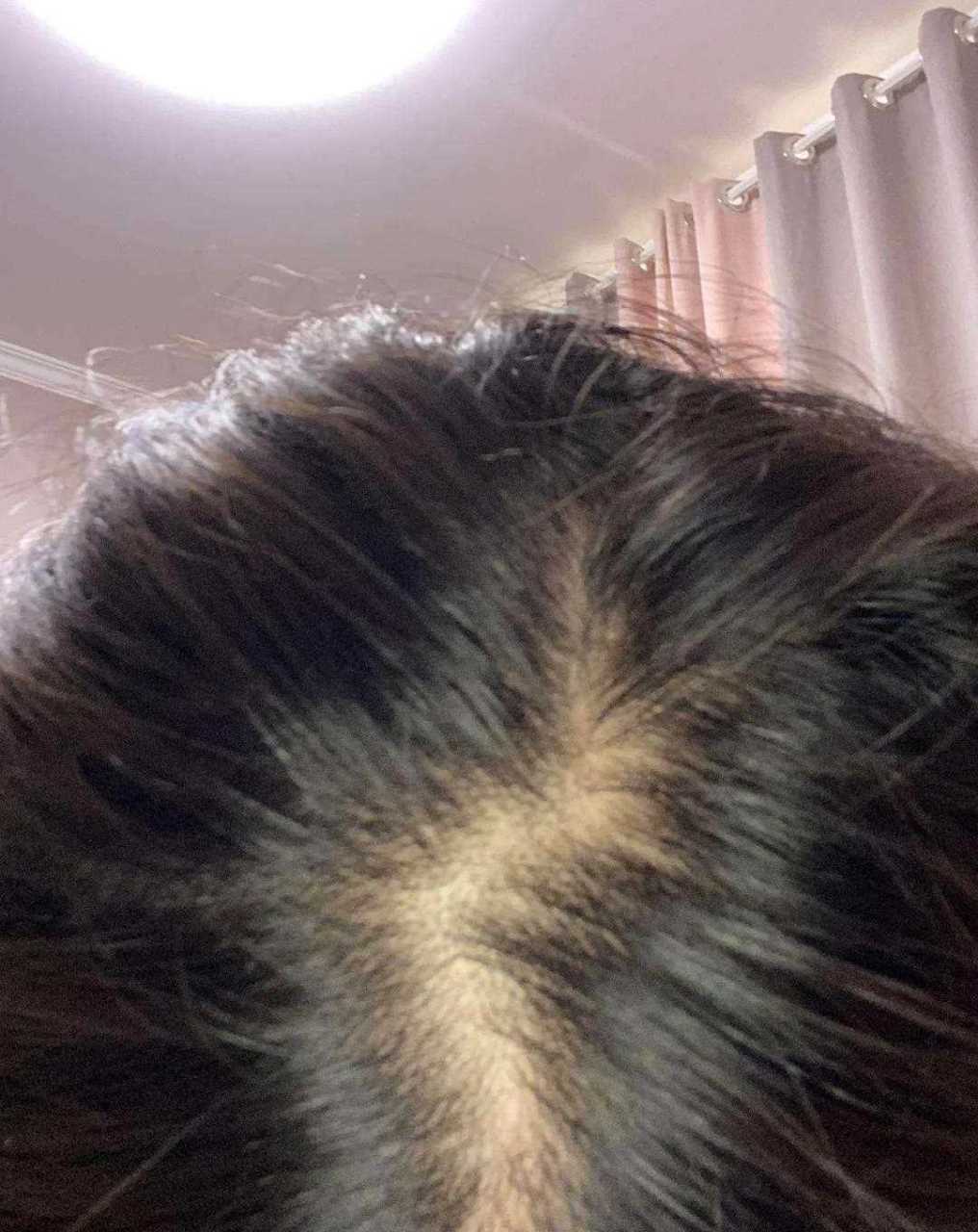 发缝宽,头顶稀疏,甚至能看到头皮的女性朋友,可以参考.