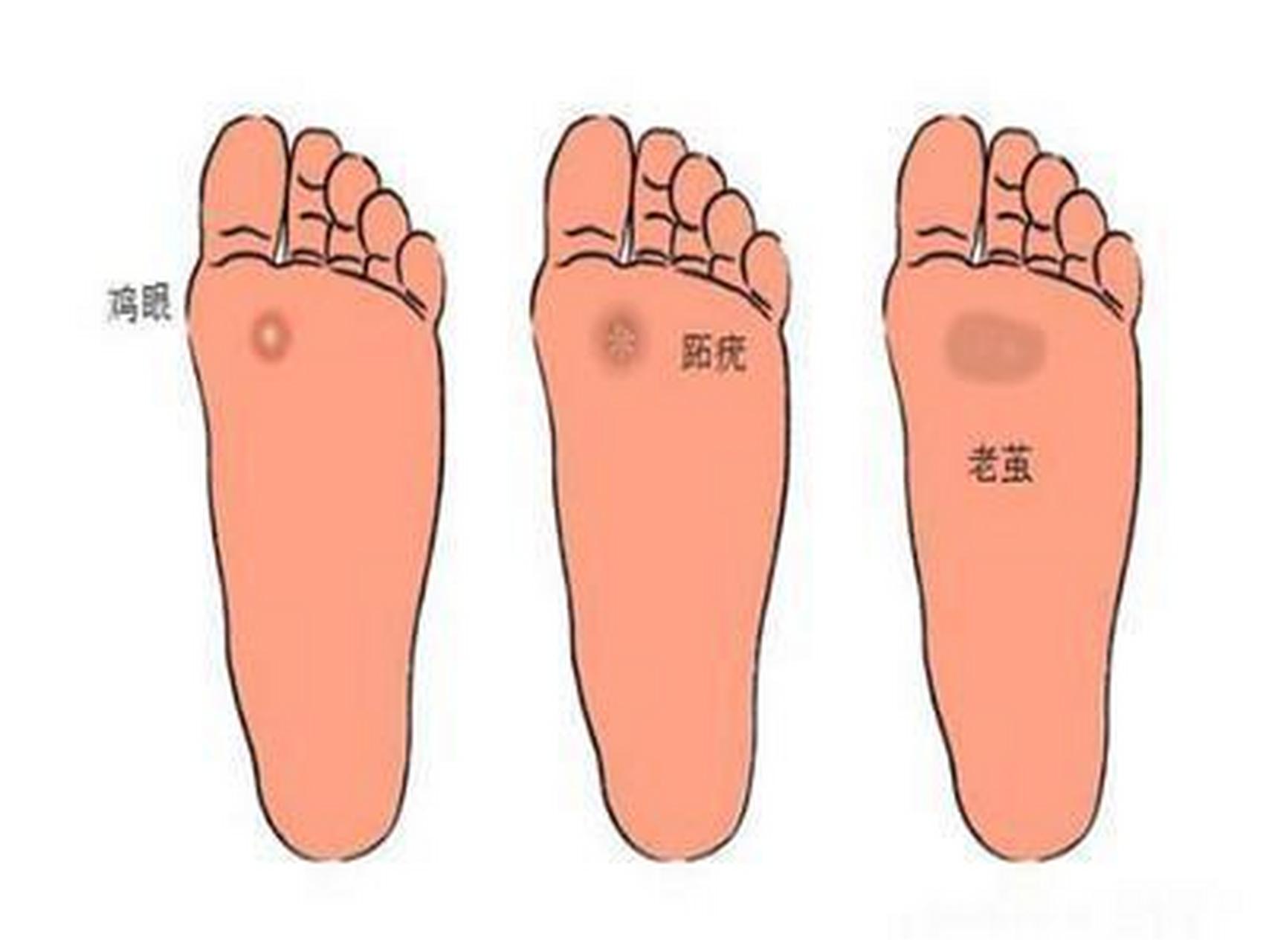 跖疣内部结构图图片