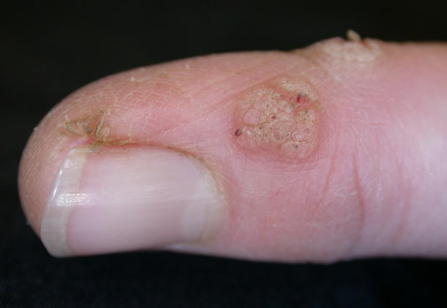 寻常疣,也叫手指疣,是一种常见的病毒感染所致皮肤病
