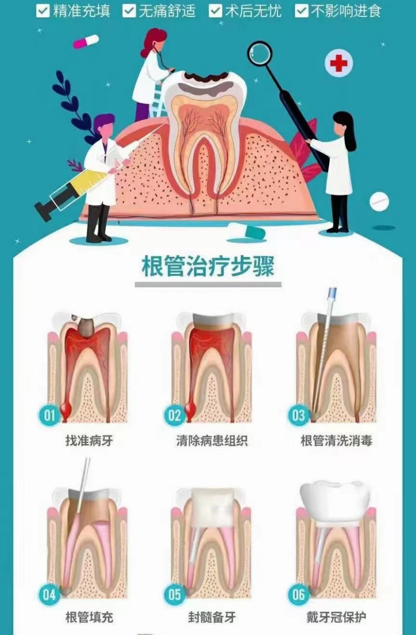 根管治疗多少钱一颗牙图片