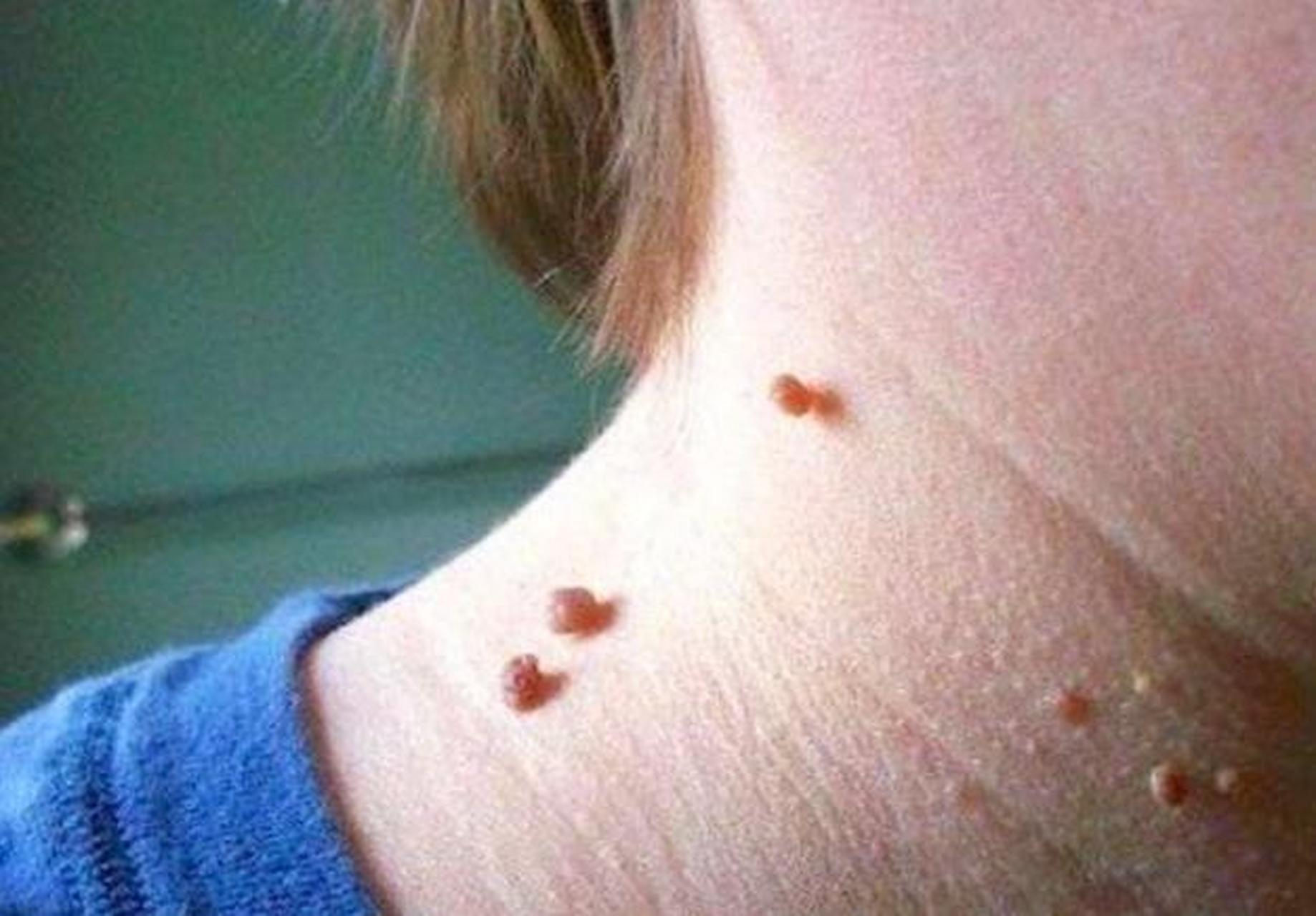 丝状疣和皮赘,医生教你根除方法