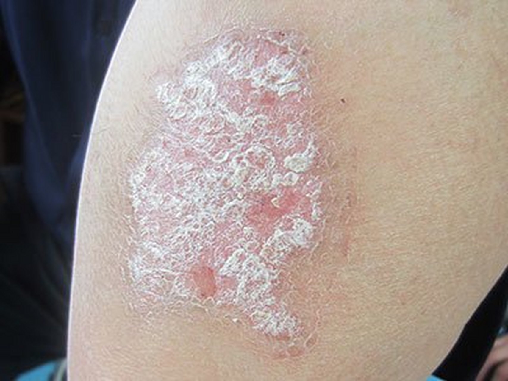 皮肤病##头部银屑病# #牛皮癣#  银屑病传染吗?