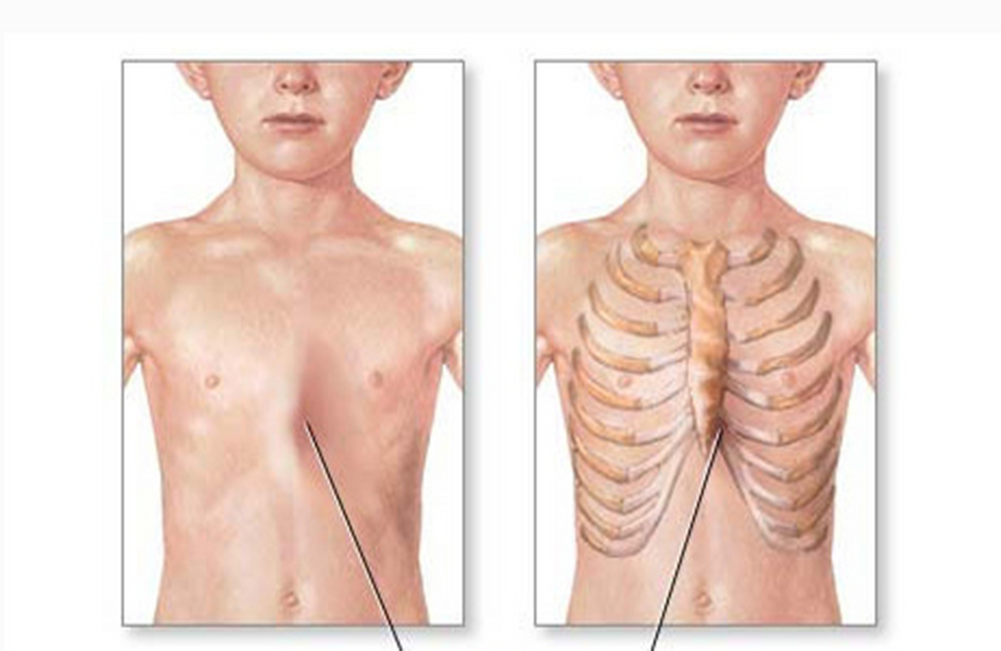 正常情况下胸骨平坦,两侧肋骨对称,鸡胸患者在胸骨前凸的同时,两侧肋