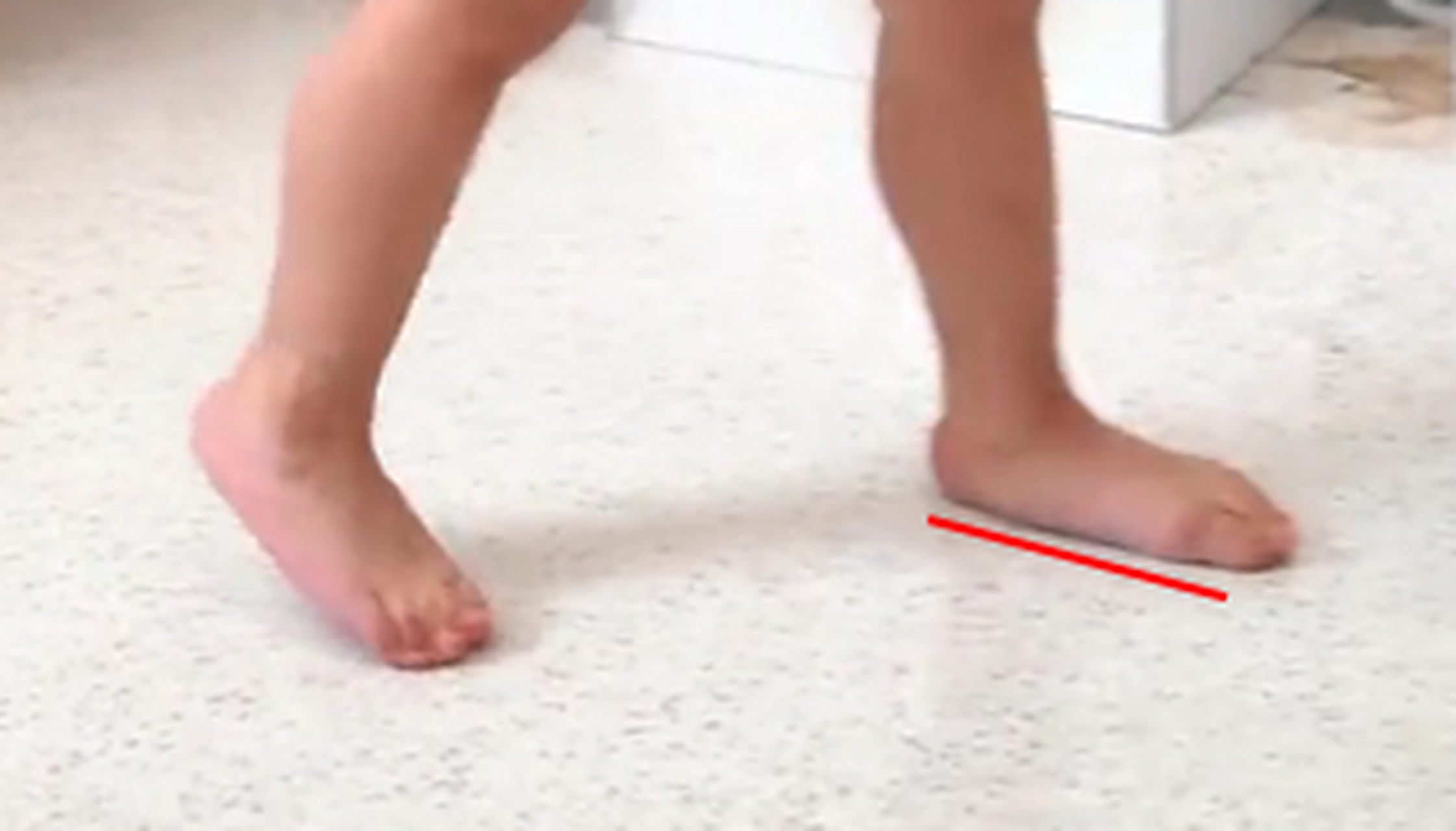 孩子走路总踮脚,脚跟不着地,跑步姿势奇怪,老是摔跤!