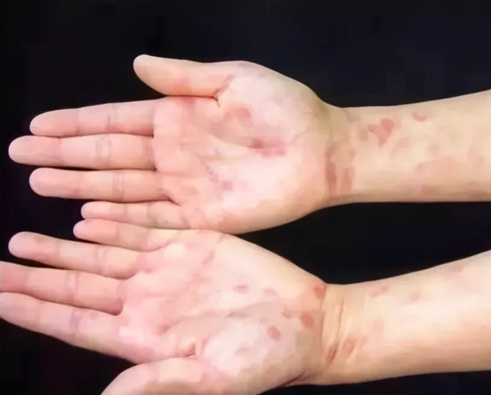 昨天门诊来了一个女生,手掌长"红斑"以为过敏了,自己买了药膏涂抹不