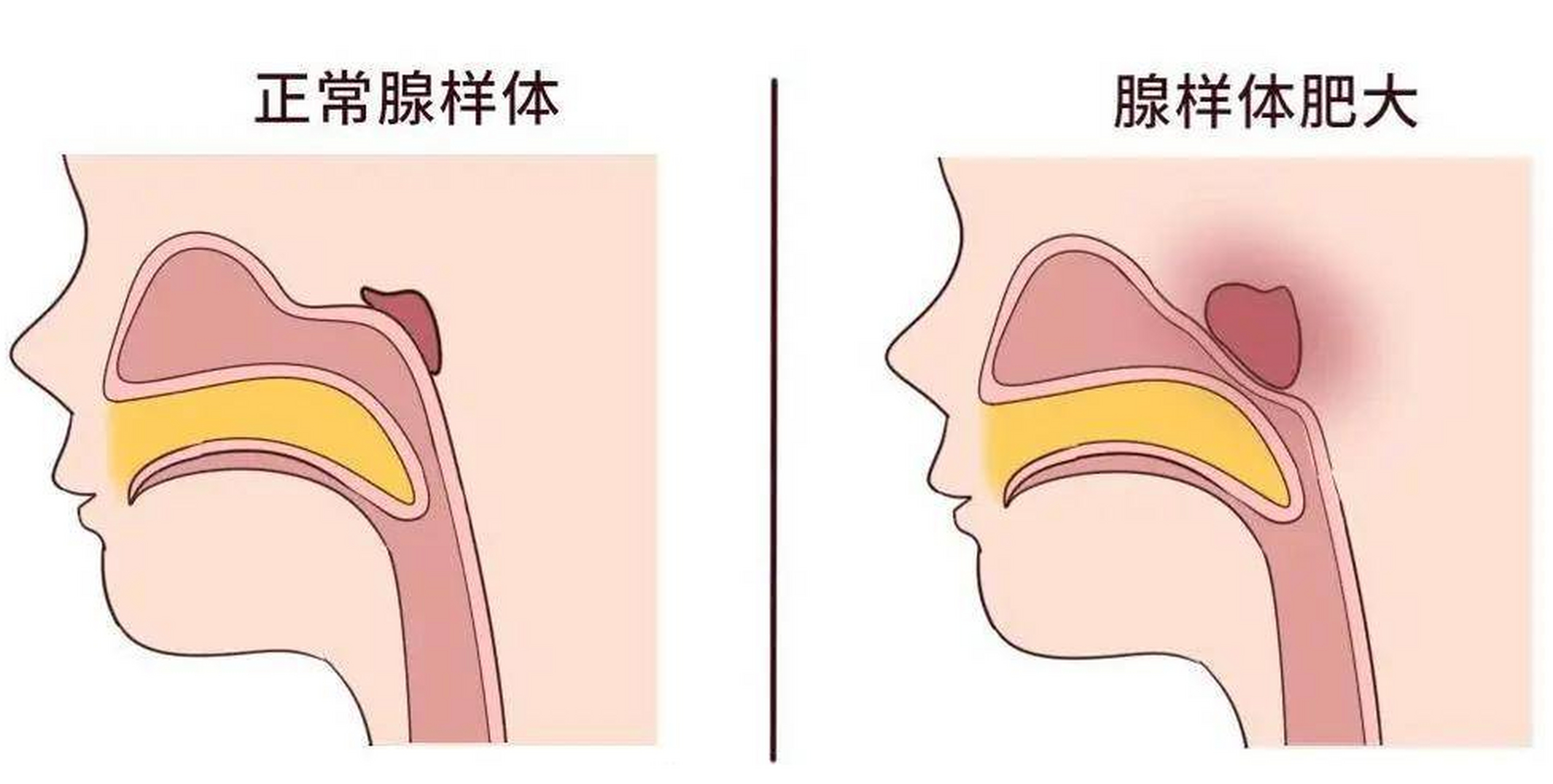 孩子身上有处开关,打开了就能缩小腺样体肥大,不知道