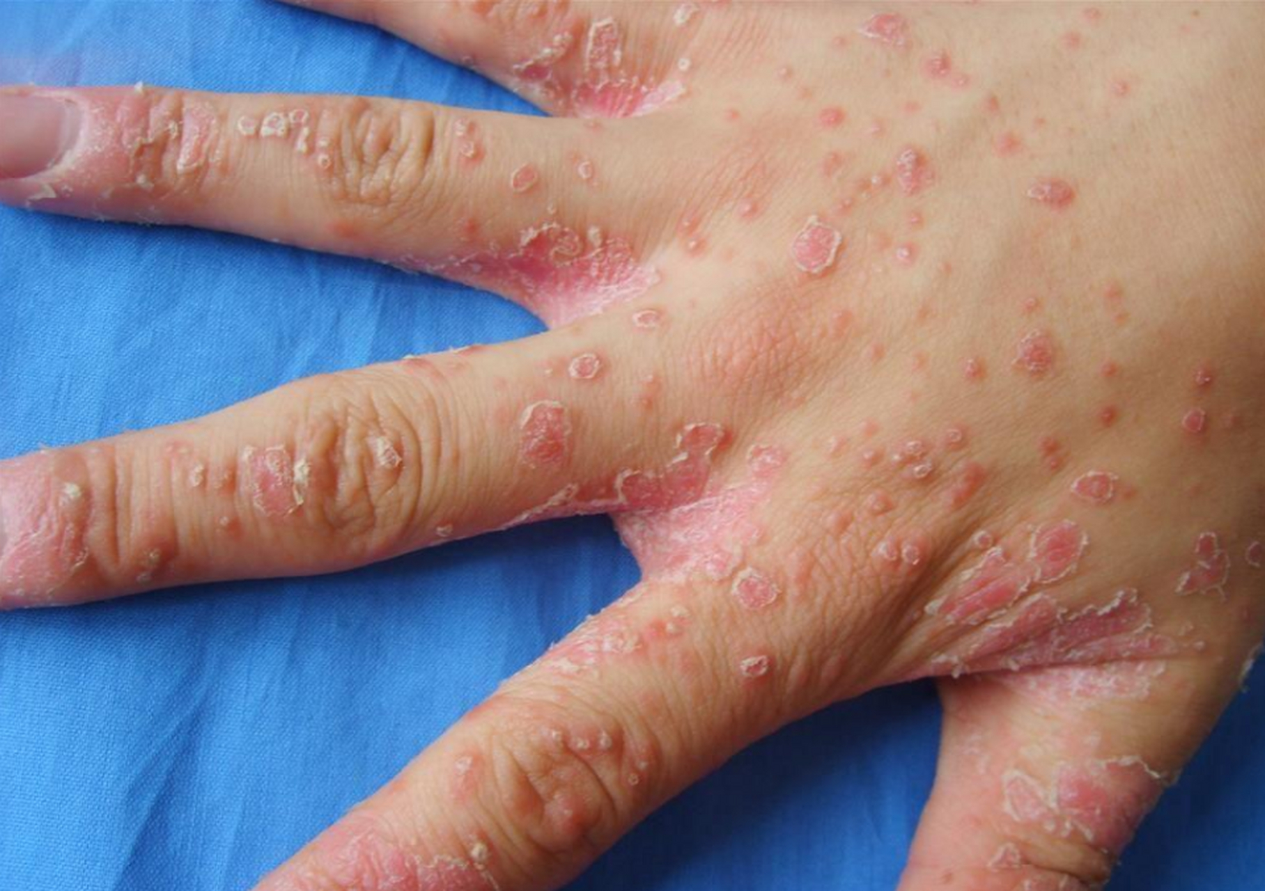 这种银屑病治疗起来最简单,90%的患者不知道!