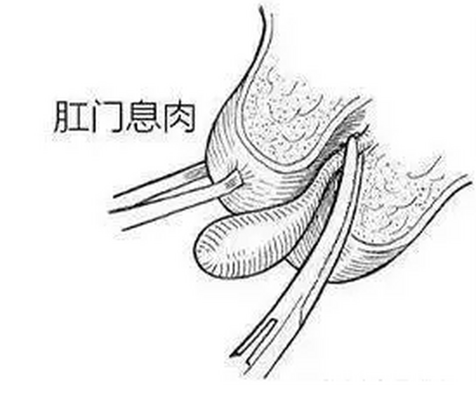 肛乳头瘤,痔疮,直肠息肉有何区别? 大家好,我是郁峰医生.