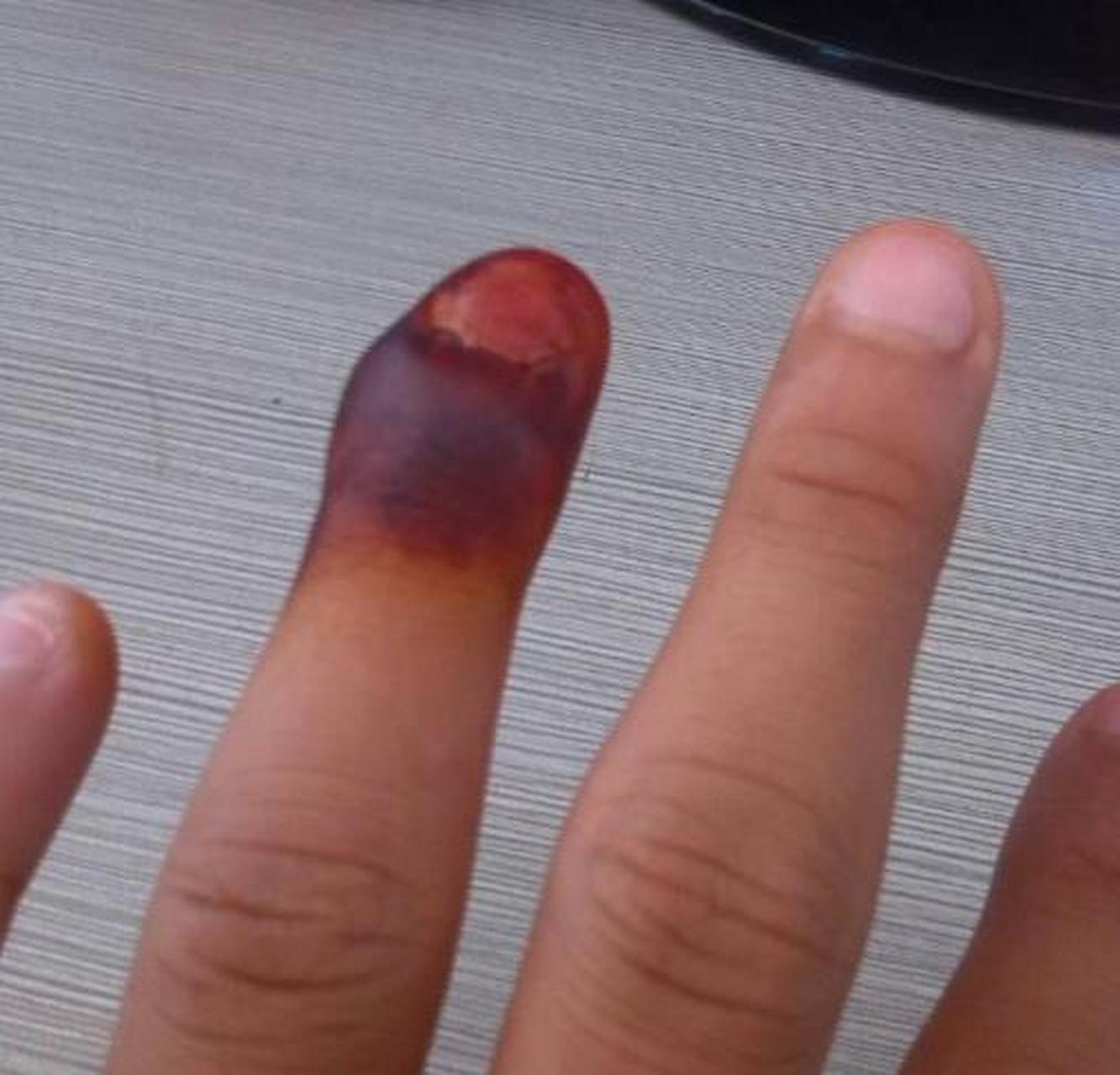 43岁的沈先生,手指突然红肿,以为是小虫叮咬,没在意,几个小时后,手指