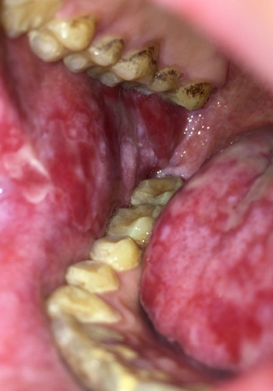 口腔扁平苔藓症状图片图片