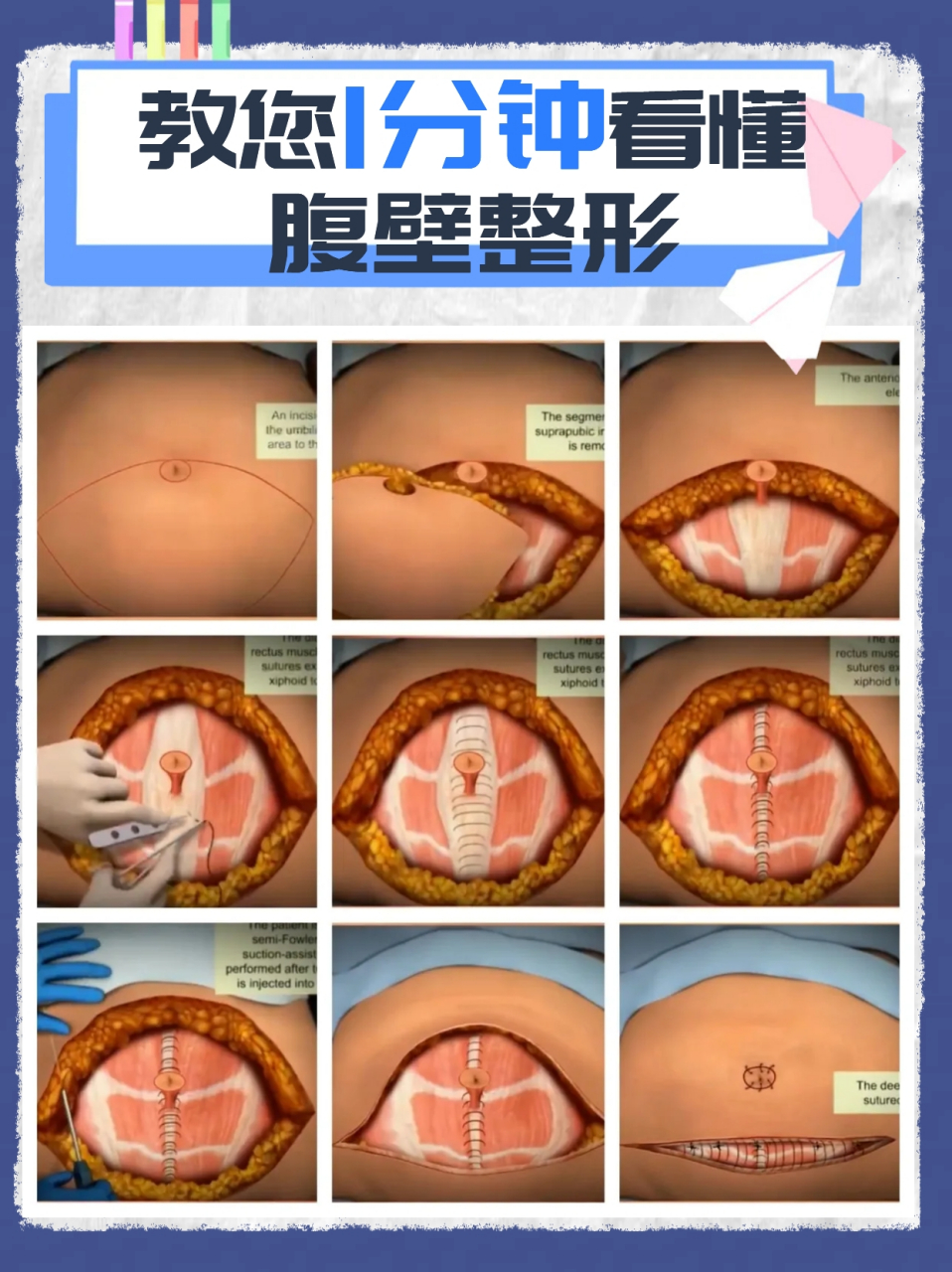 这位患者就是多次经产或者减重,大量减重引起的腹壁松弛