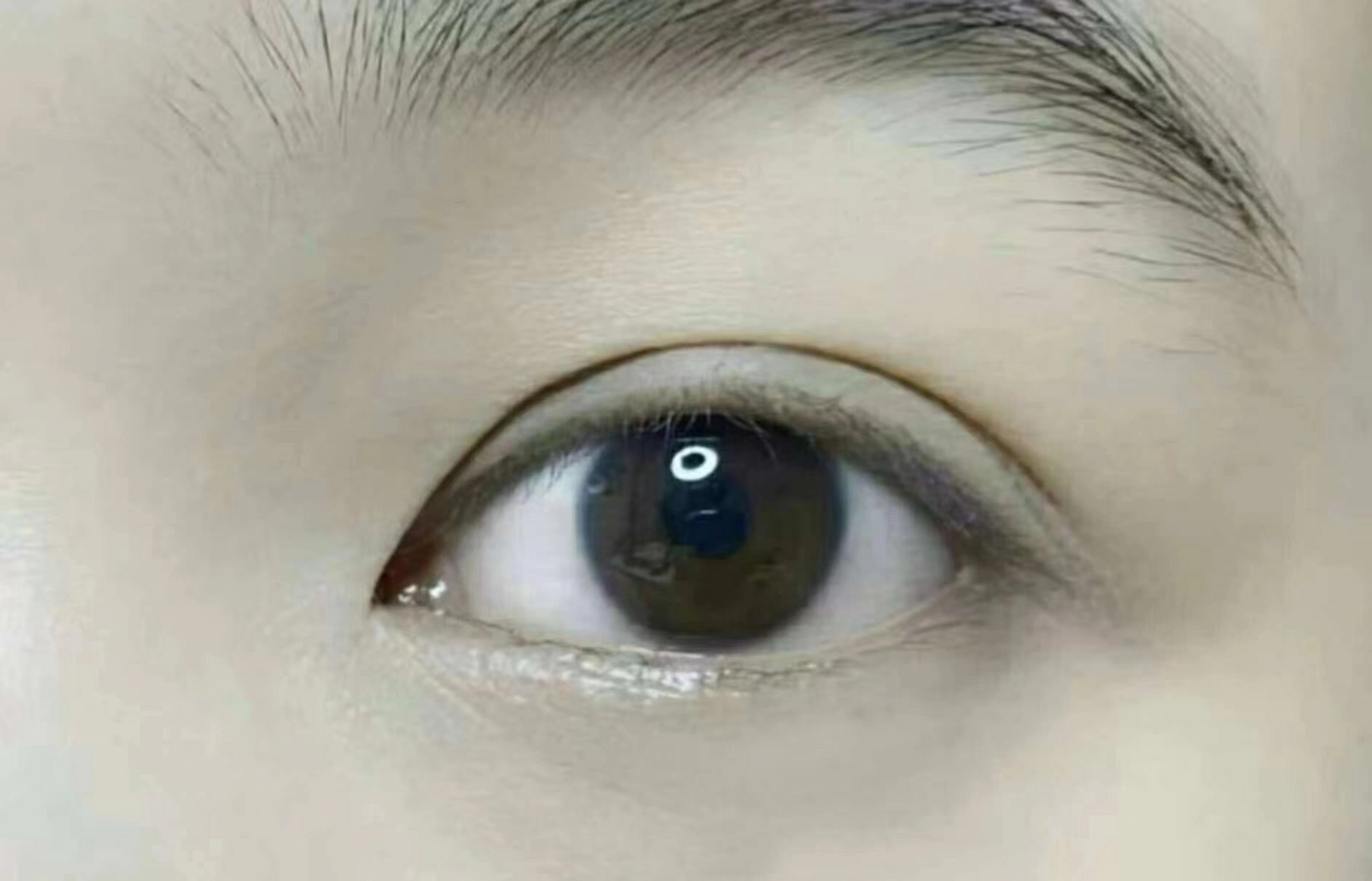 开扇7mm双眼皮,做完两个月,肉条基本消失了,说这就是自己想要的样子.