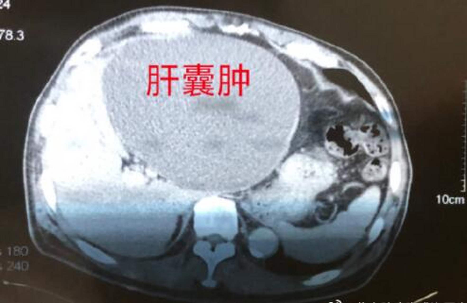 体检报告中的结节,囊肿,息肉都代表什么?该如何处理?一文说清