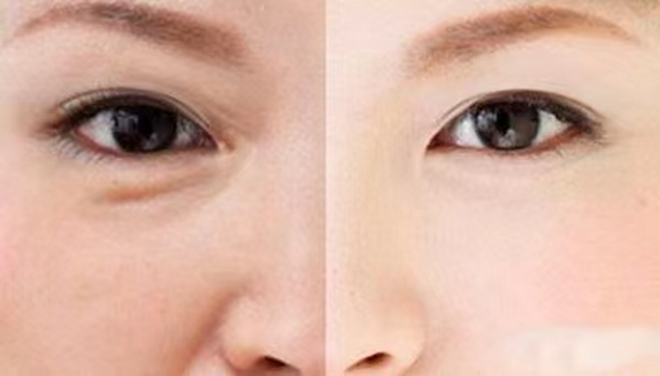 适应症:抚平泪沟,淡化黑眼圈 适用部位:泪沟,黑眼圈 #眼周抗衰#  3.