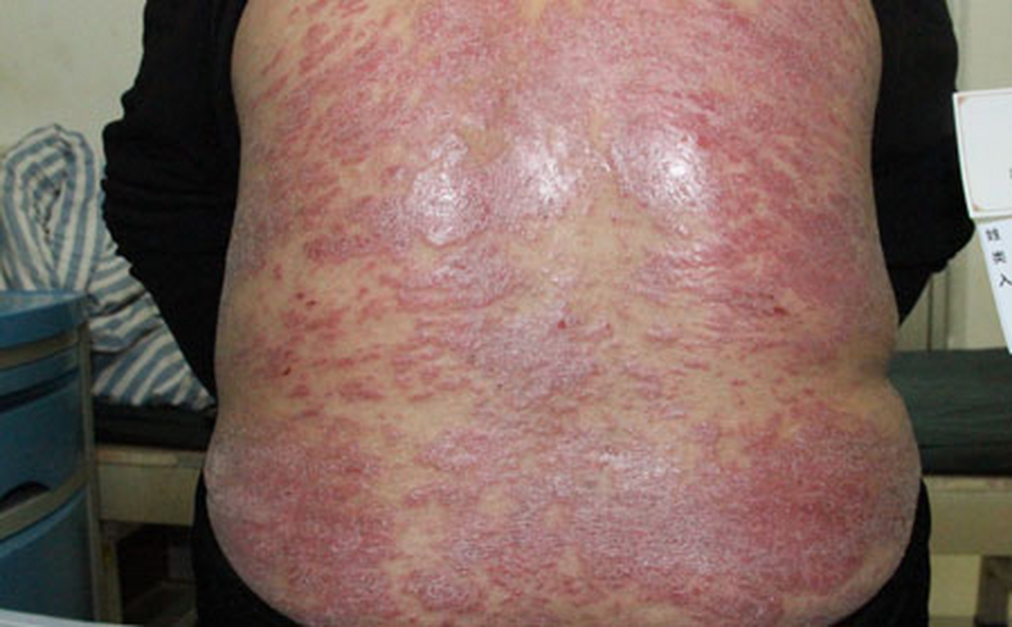 全身牛皮癣皮肤越来越好,他是怎么做的 全身长满了牛皮癣,不到一个月