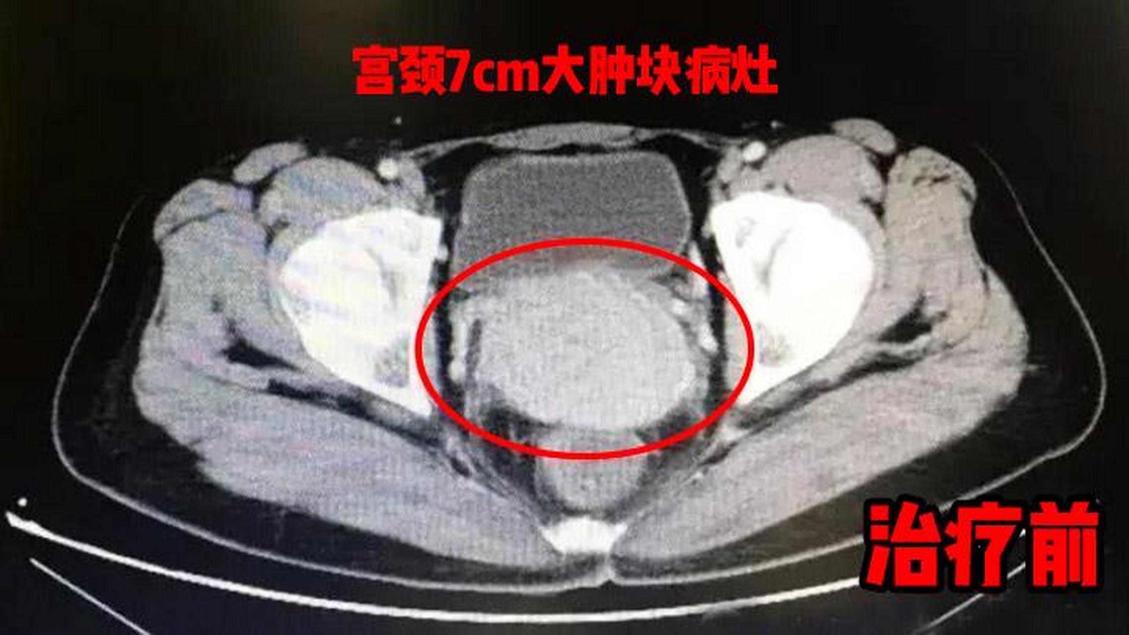 宫颈癌图片晚期图片