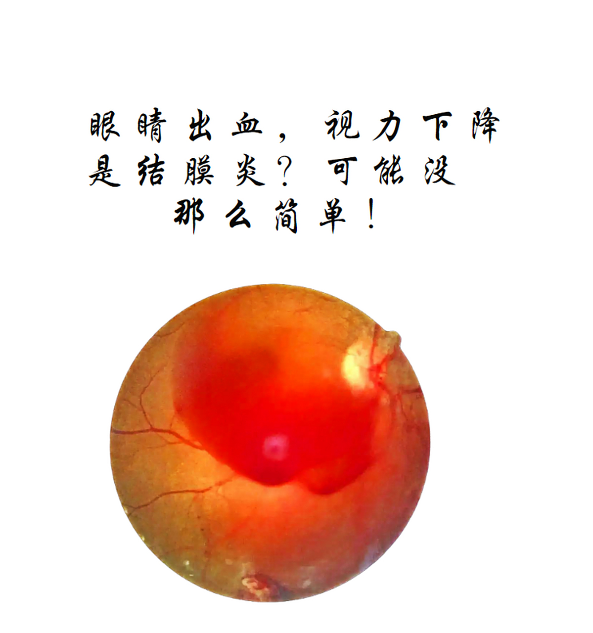 玻璃体积血是眼外伤或视网膜血管性疾病造成视力危害的一种常见并发