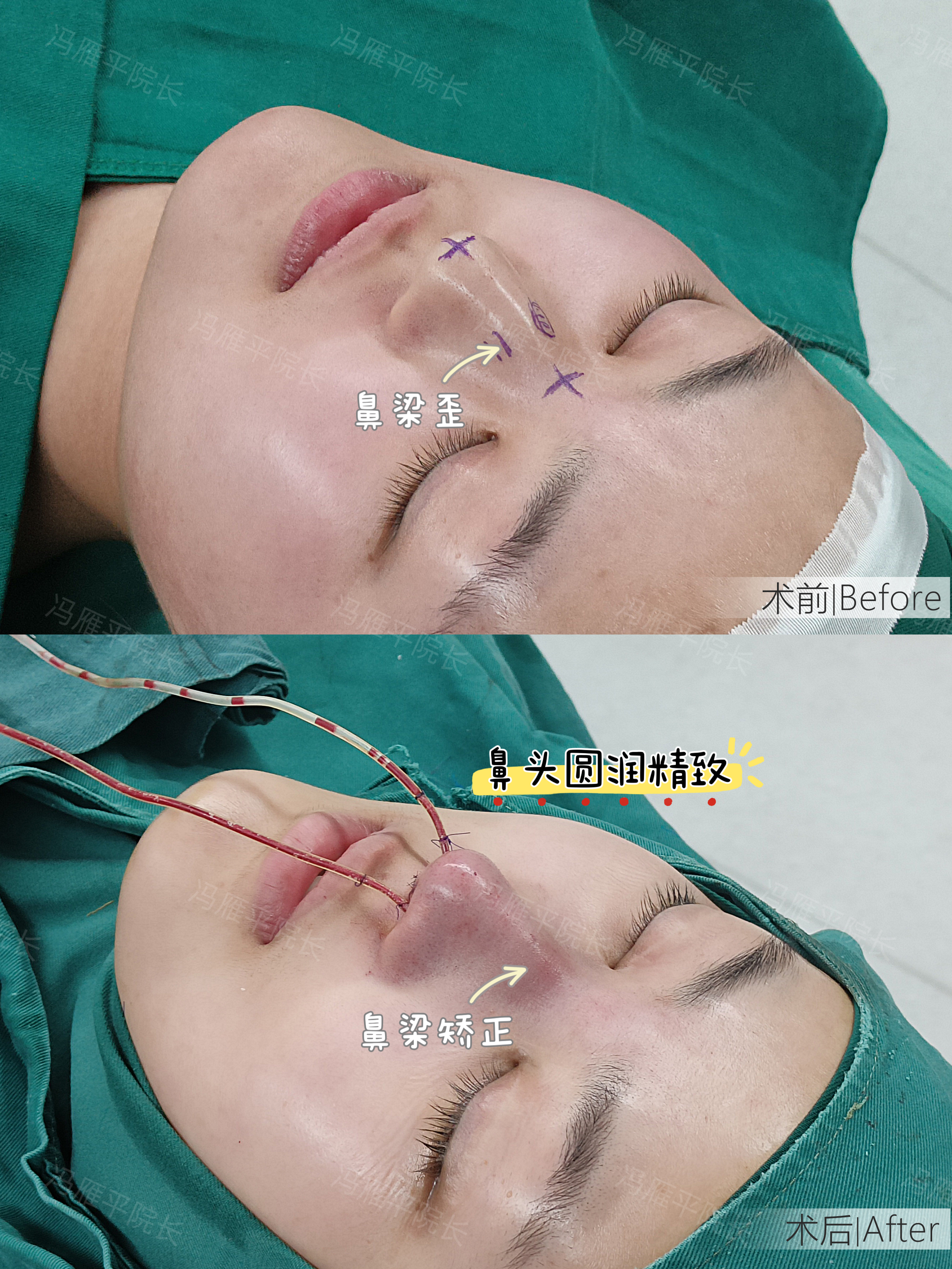 轻微的#歪鼻# 是可以通过隆鼻手术矫正的
