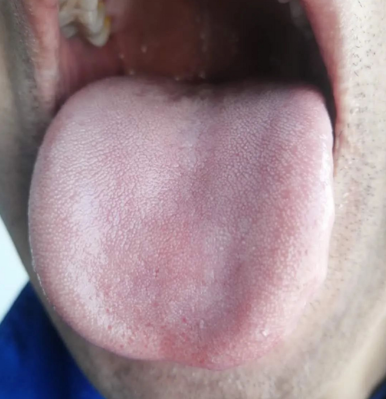 寒性舌苔的图片图片
