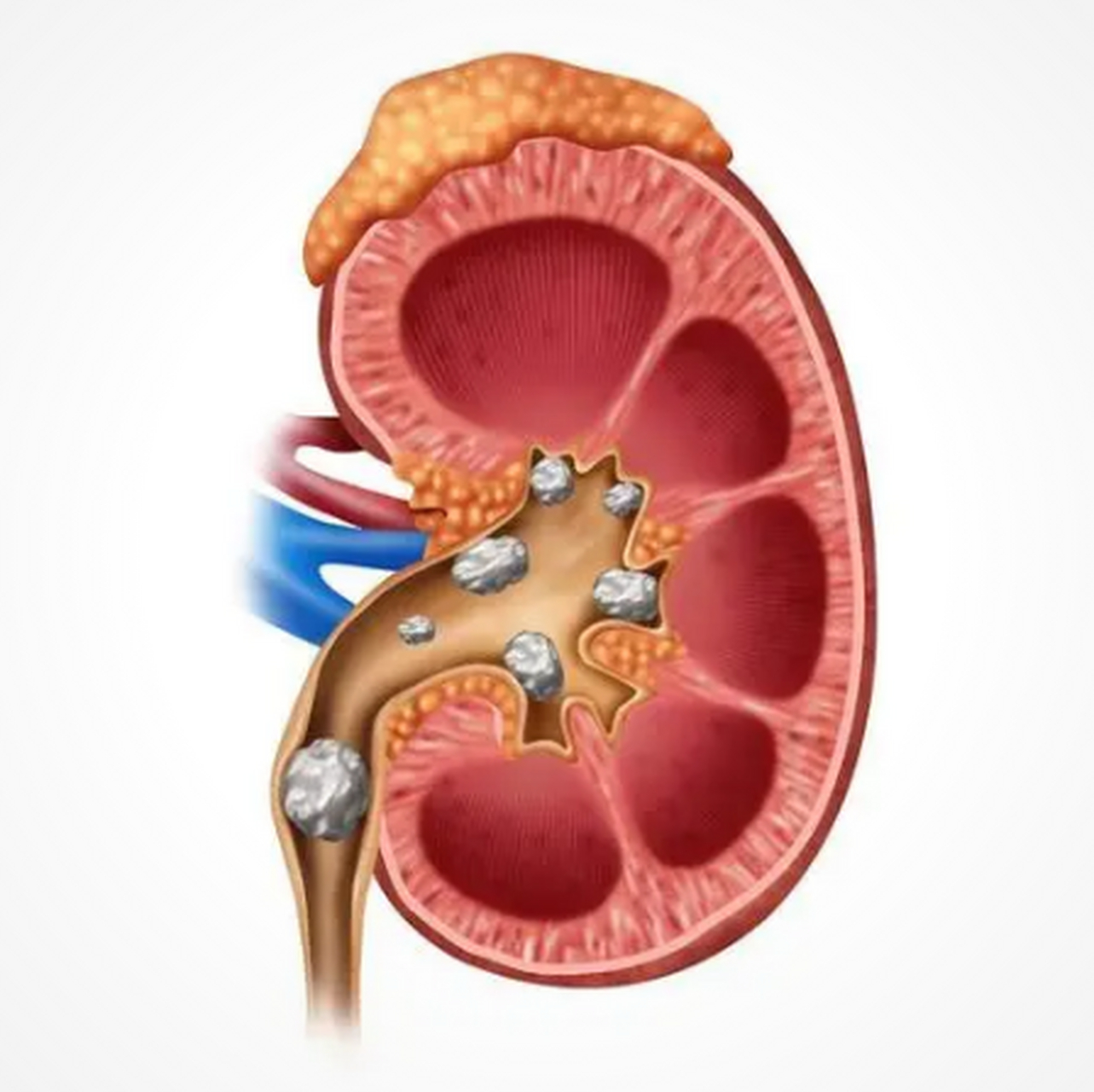 肾结石结构图图片