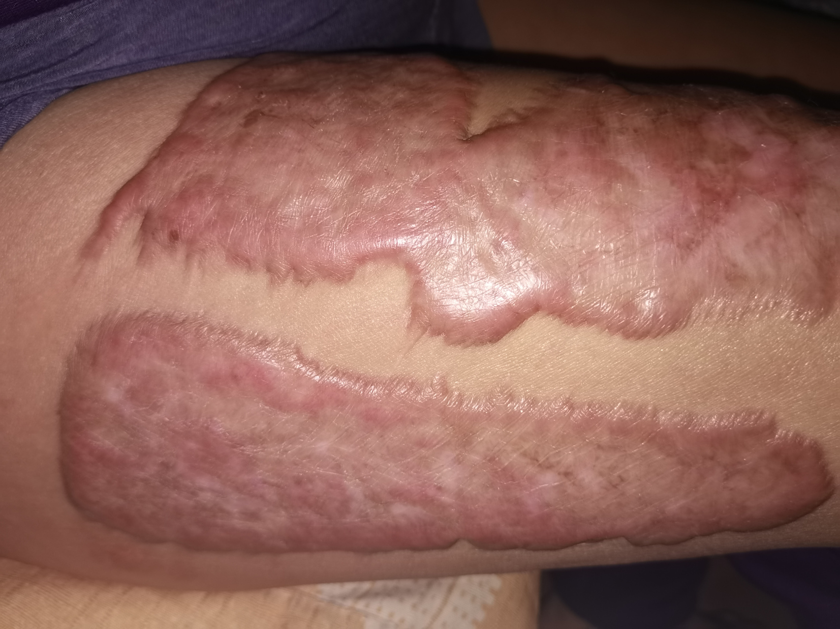 疤痕增生# 常见于外伤,手术后,由于皮肤纤维结缔组织增生过多,谐缮