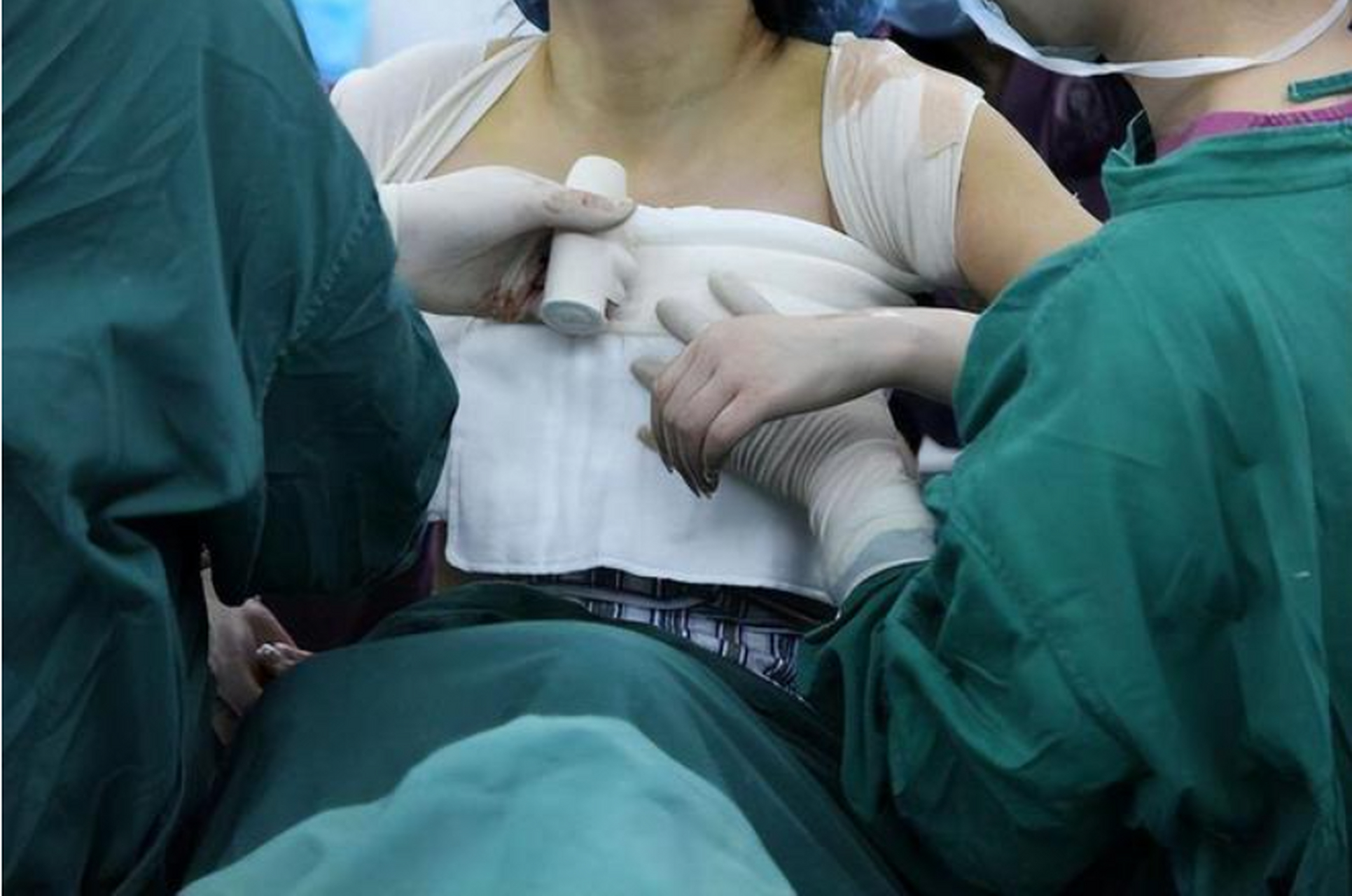 有些求美者很瘦,假体隆胸后希望修饰形态,我们可以