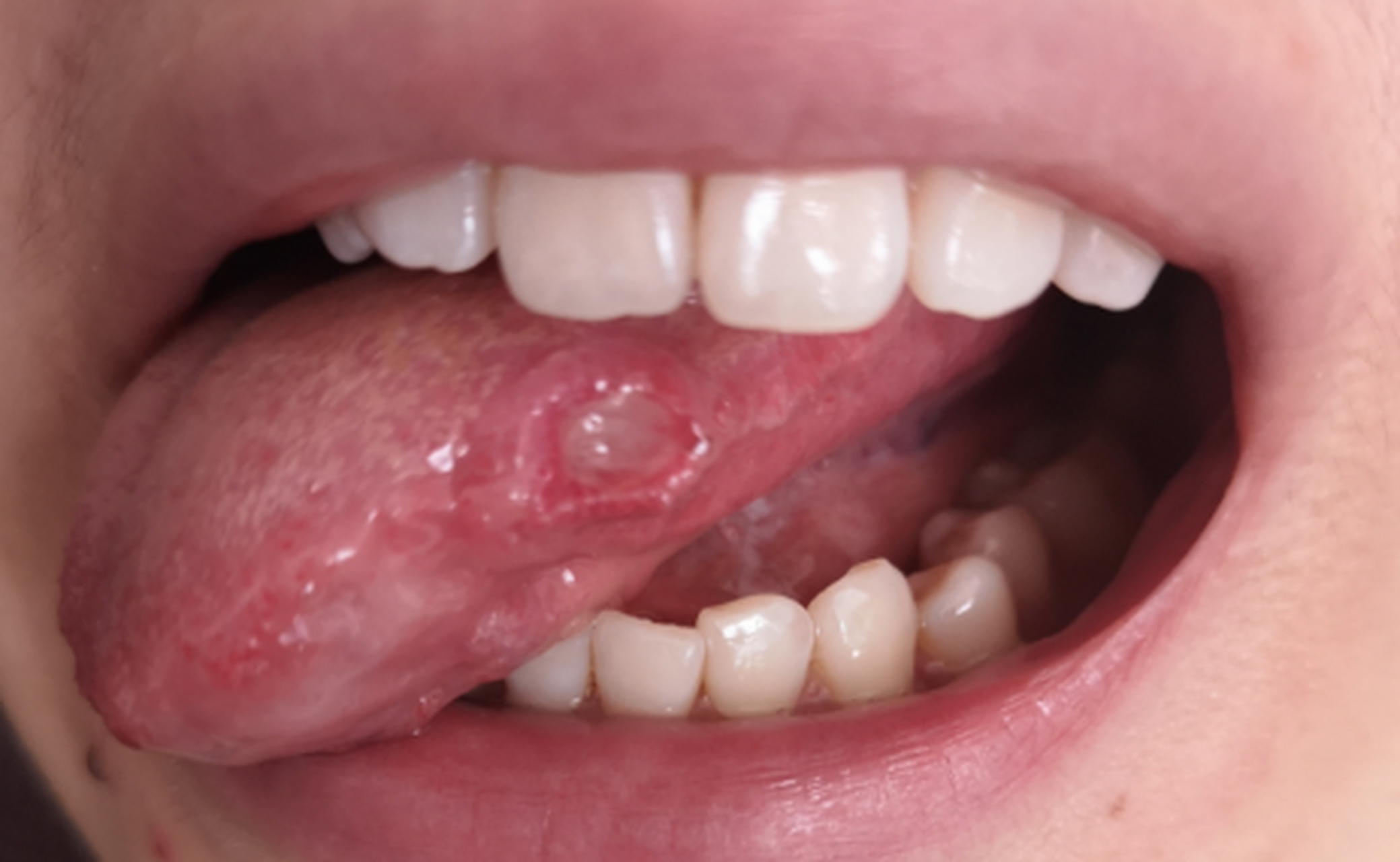 经期总是长口腔溃疡,原来和这些有关.