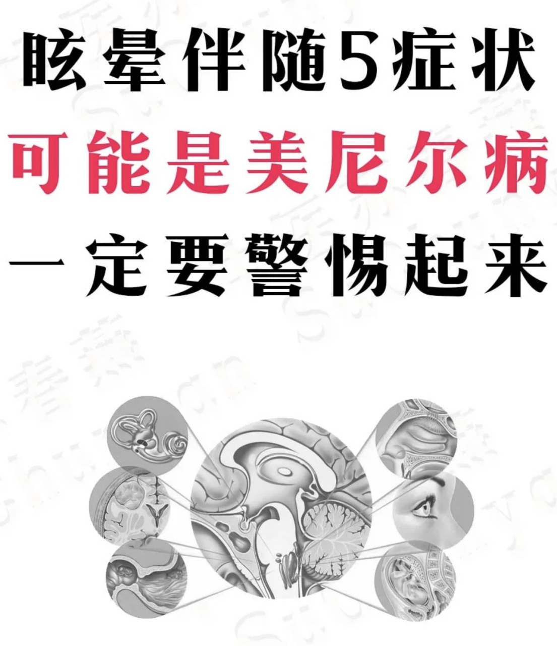 眩晕# ,伴随5症状,可能是#美尼尔# 病 梅尼埃病曾称美尼尔病,是以