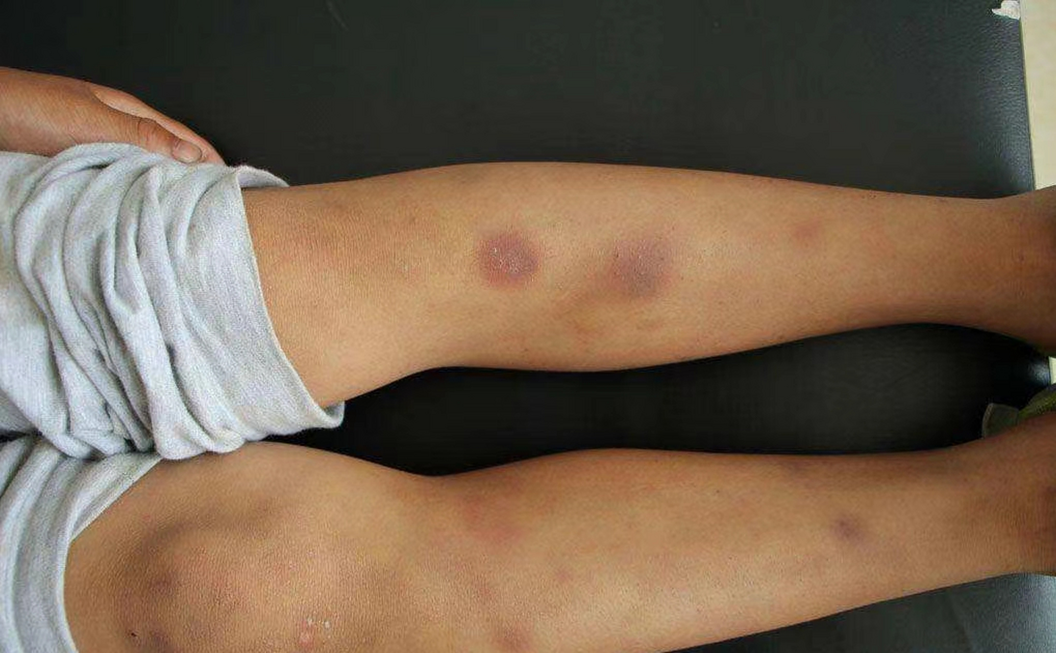 出现以下4个症状,需要注意血小板减少症!