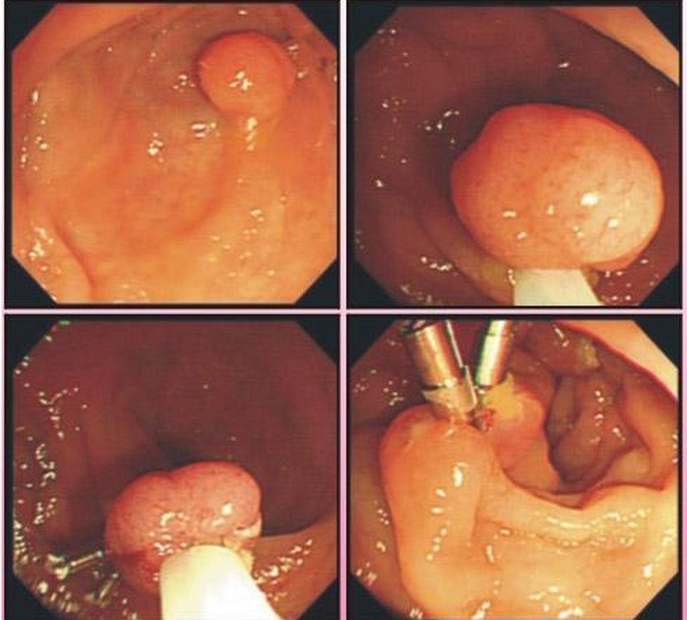 肠息肉手术夹子脱落图片