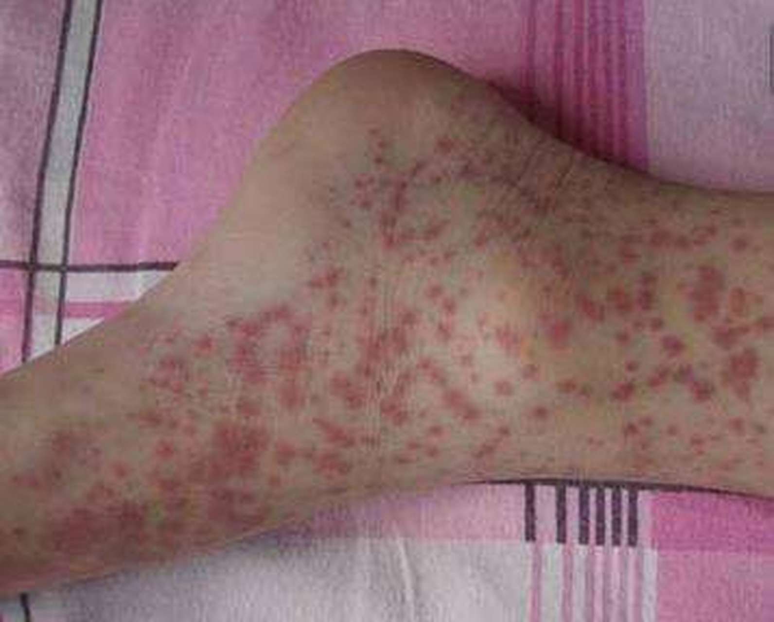 紫癜# #惠州皮肤科医院# 紫癜统称皮肤上出现的出血点或出血斑,可由