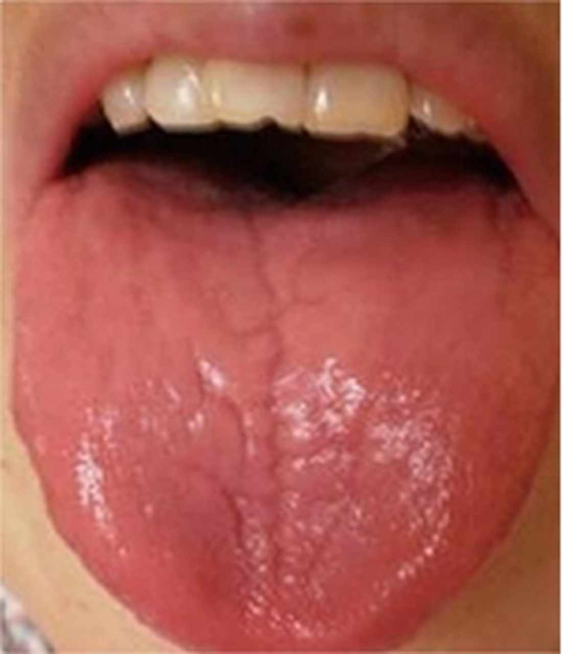 舌红少苔正常图片大全图片