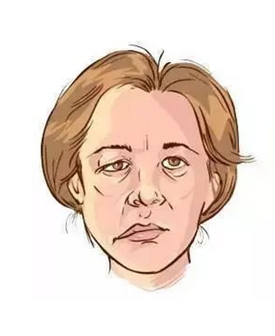 面肌抽搐的症状表现和治疗方法    面肌抽搐又称面肌痉挛,其常见