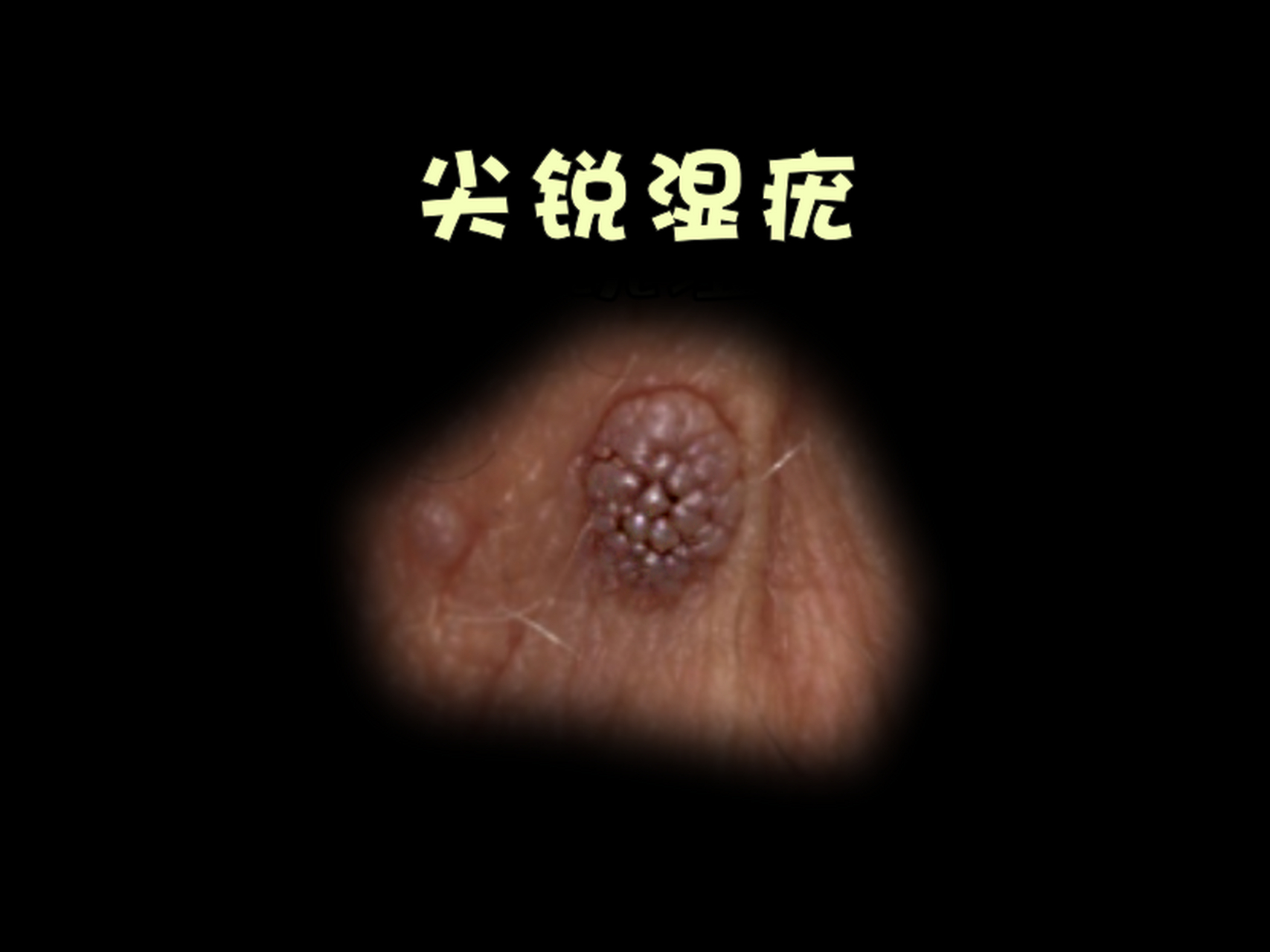 尖锐湿疣的症状感受是怎样的?治愈可能吗? 大家好,我是皮肤科朱医生!