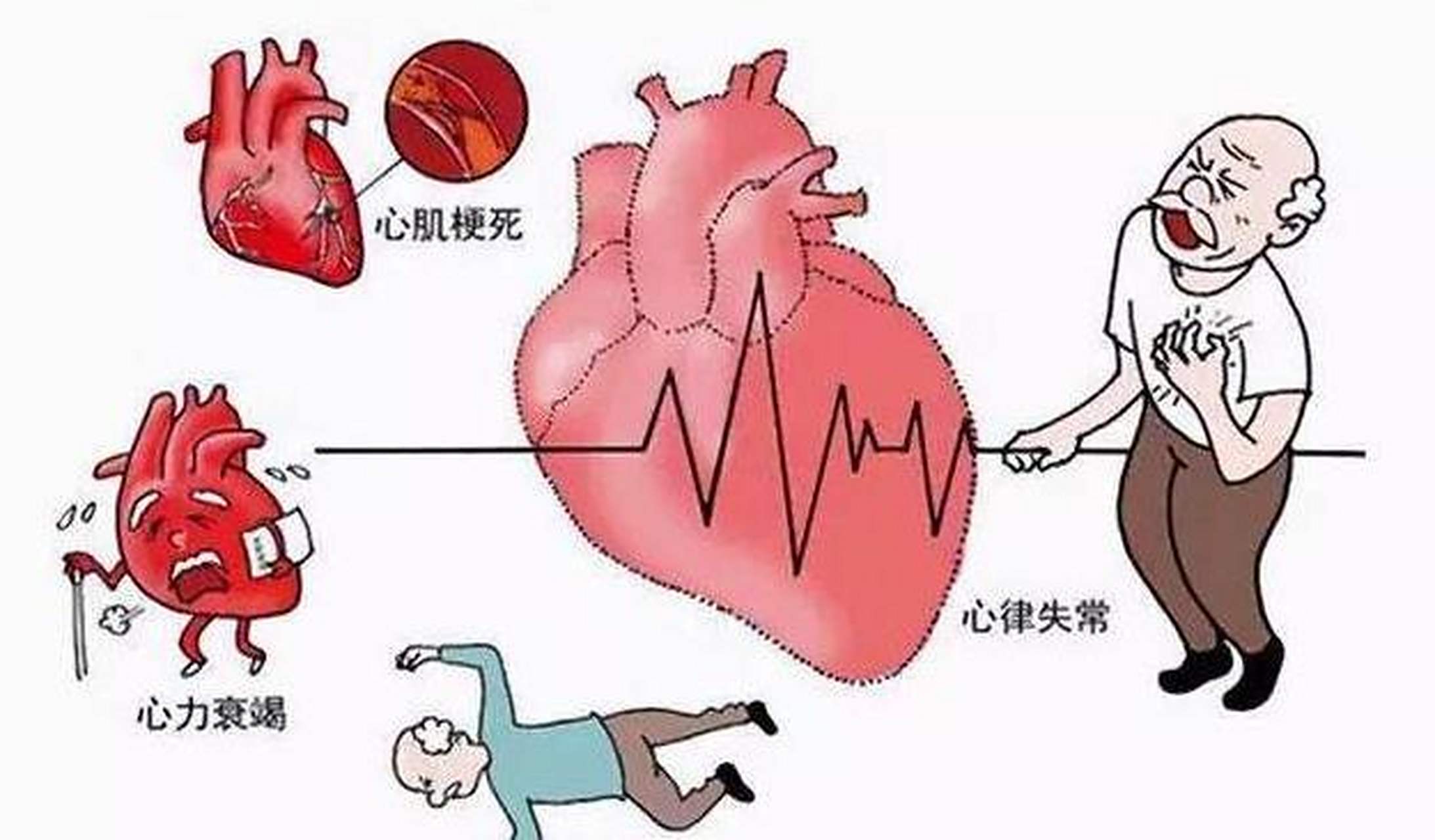 冠心病的早期八大症状,希望大家一个也没有!