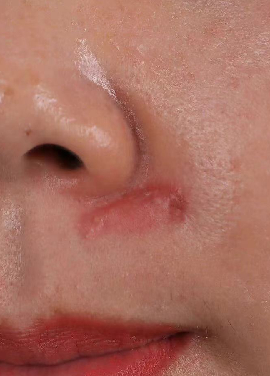 当我们受伤后,伤口的增生是一个常见的问题.