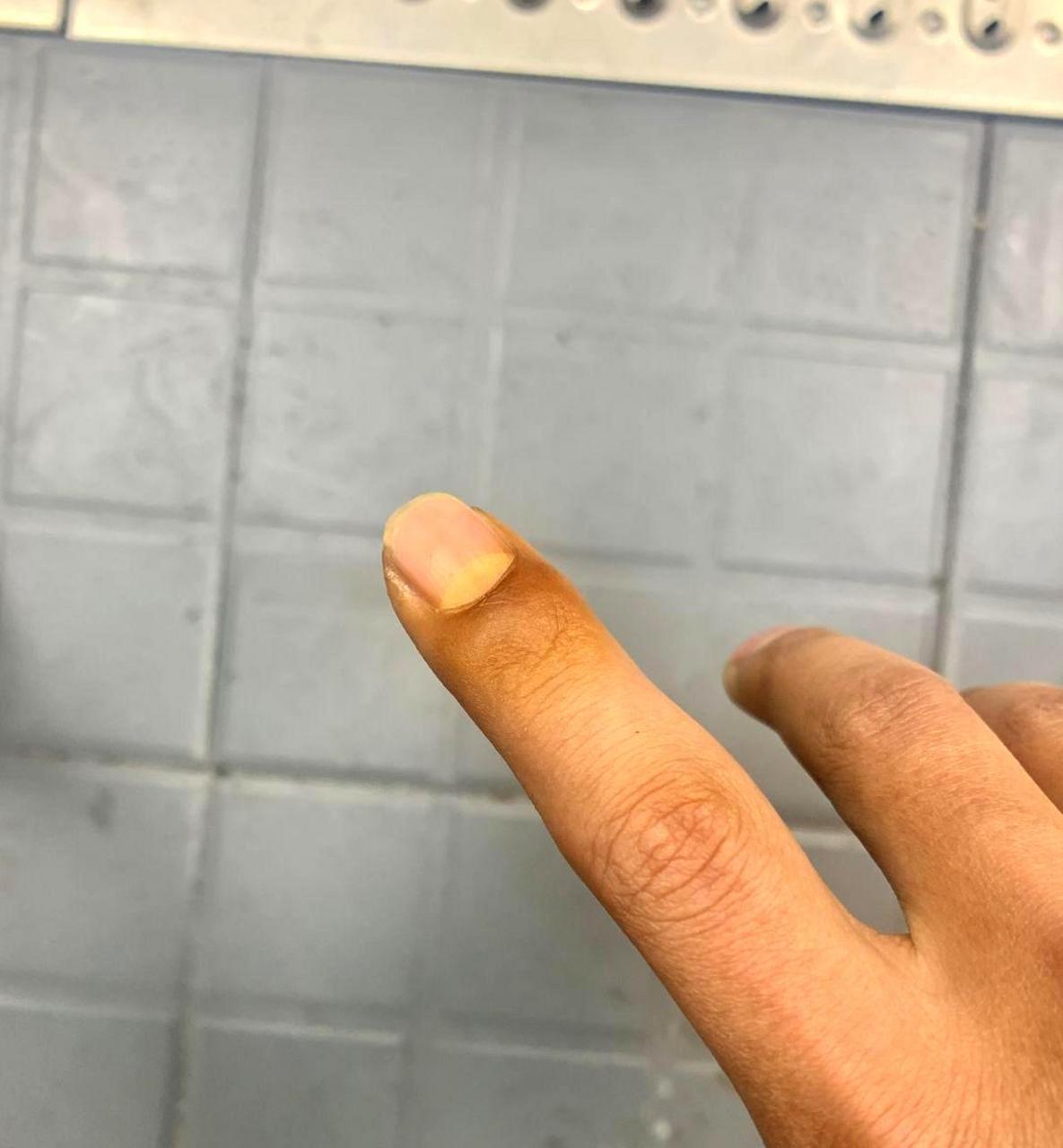 手指头突然变黄,这是怎么回事呢?