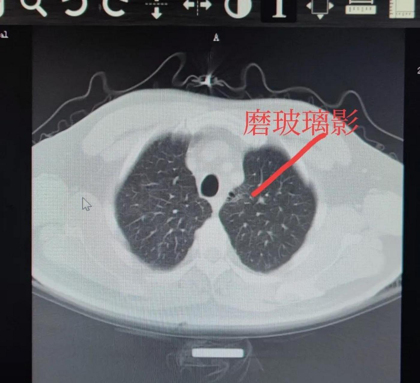 五年烟龄的肺图图片