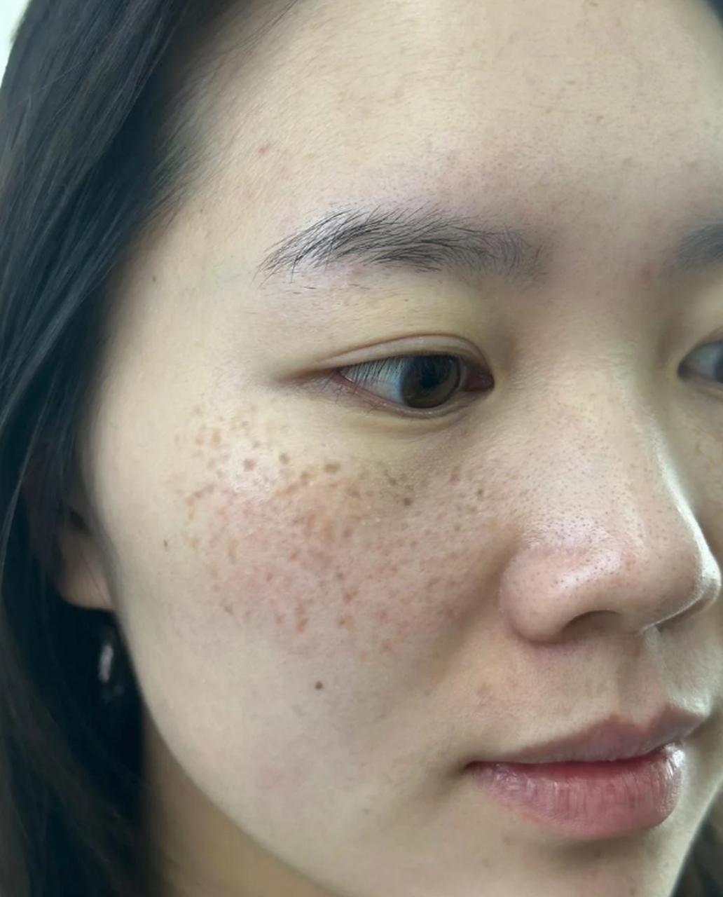 那么,色素斑是如何形成的呢?