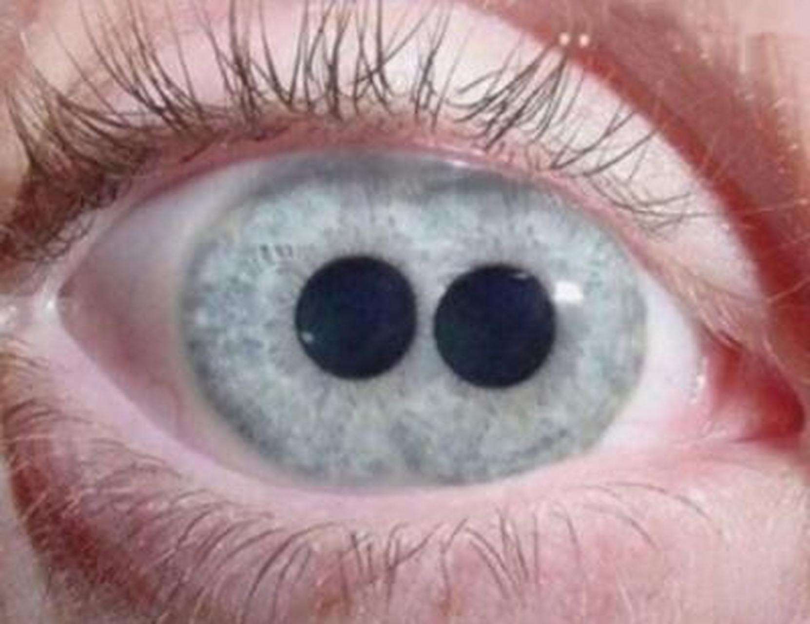 双瞳孔是一种极为罕见的情况,即一个人的一只眼睛里有两个瞳孔.
