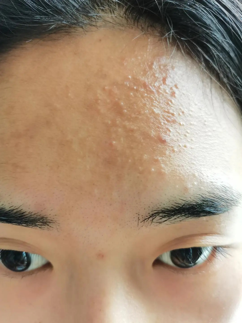 很简单,痘痘发炎红肿主要是痤疮杆菌在作怪,而蓝光恰是痤疮杆菌的