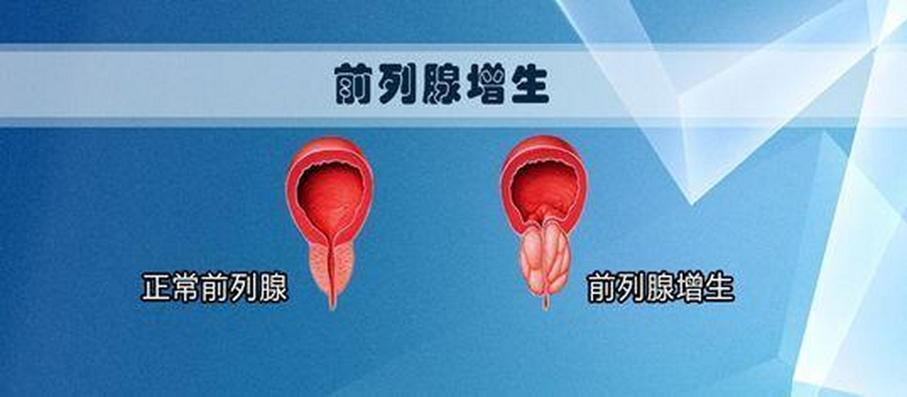 诊断男性发生前列腺增生症的5种常用方法 诊断前列腺增生最常用的