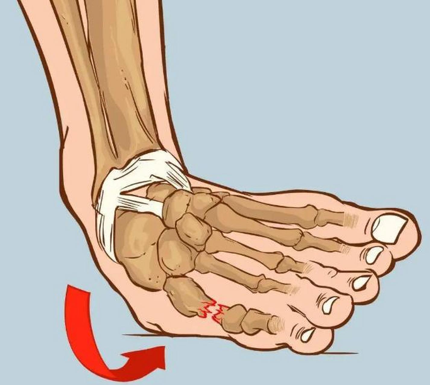 崴脚之后,这三点非常非常重要 第一点我们崴了脚以后,要立即休息,不能