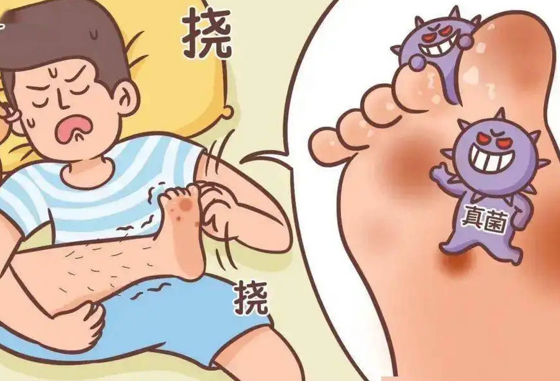 南京皮肤病研究所# #南京皮肤病研究所在线预约# #手廯#  足癣就是