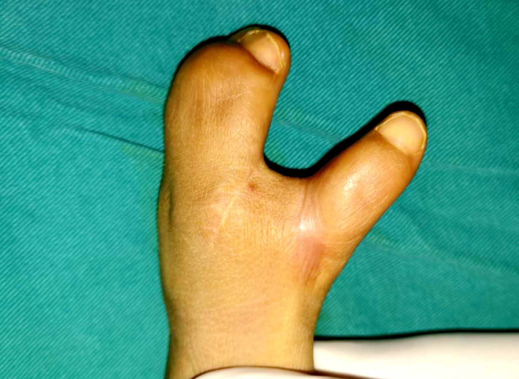 宝宝的手像铲子一样,尽快手术也可以长大 宝宝的手像铲子一样,这个在